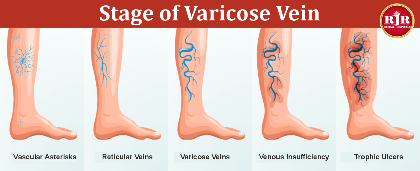 pcod treatment in chennai tamilnadu
